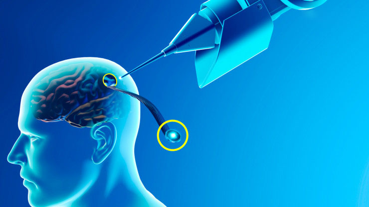 How Can I Buy Neuralink Stock Today